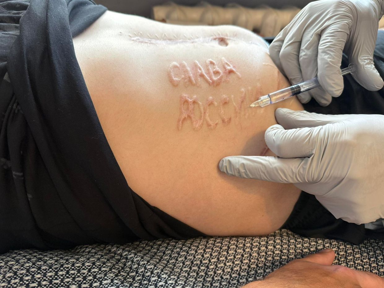 The words "Glory to Russia" branded onto the wounded Ukrainian POW by a russian doctor during an operation.