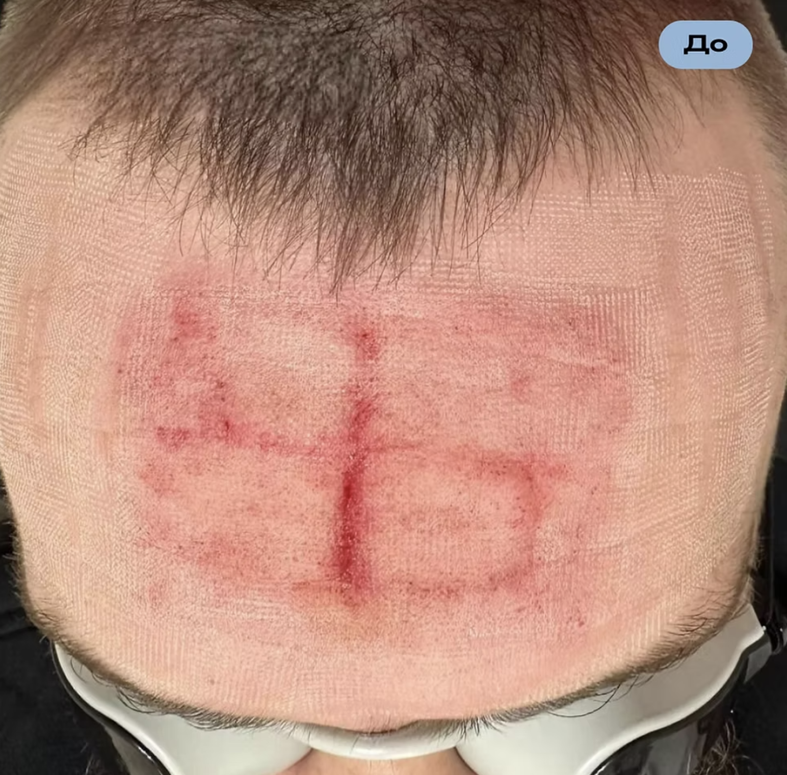 Several Ukrainian defenders returned from the russian captivity with swastika-shaped scars, some on their foreheads.Several Ukrainian defenders returned from the russian captivity with swastika-shaped scars, some on their foreheads.
