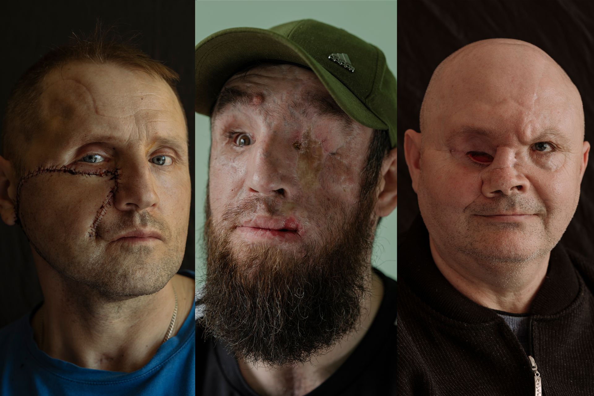 US surgeons restore dignity for Ukrainian soldiers with facial wounds